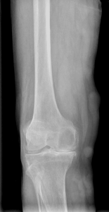 Artrosis de rodilla esquema