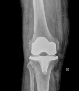 Artrosis de rodilla detalle